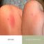Before-and-after comparison of skin irritation on a knee, with the left side labeled BEFORE and the right side labeled AFTER 45 MINUTES.

